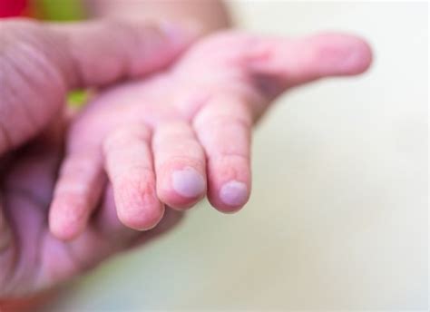 Bolha No Dedo De Bebe - Bolhas nas crianças: como cuidar? - Sou Mamãe