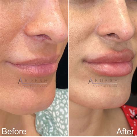 Facelift Before and After | Ardesh Facial Plastic Surgery