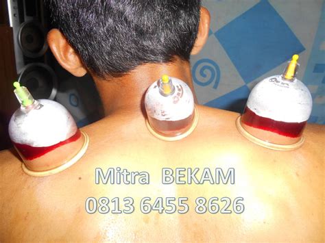 bekam malang raya jenis jenis bekam