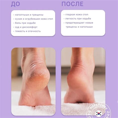 Средство для педикюра ЧУДО ПЯТКИ | Купить в интернет-магазине MaskShop