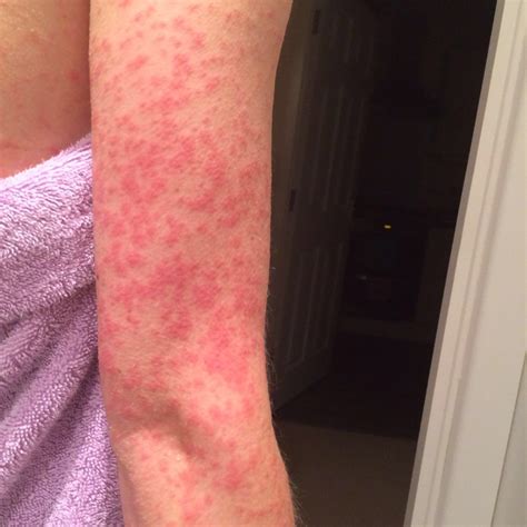 Viral Exanthem