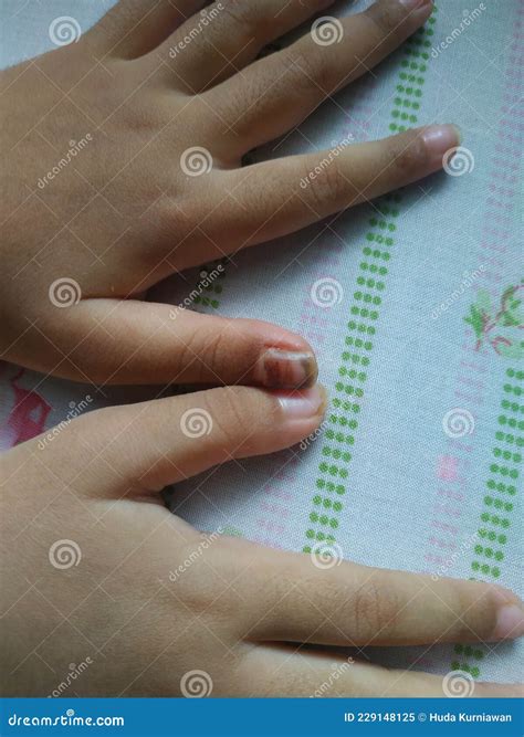 The Child& X27;s Finger Was Broken by Being Pinched by the Door Stock