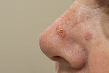 Базальноклеточная карцинома кожи. Лечение в Киеве | EuroDerm
