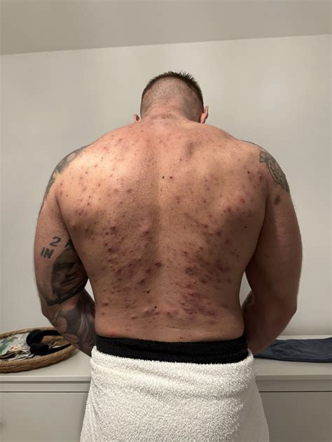 Bacne from steroids : r/acne