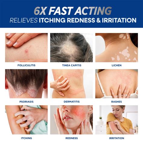 Folliculitis Treatment Cream: Effective Treatment for Folliculitis