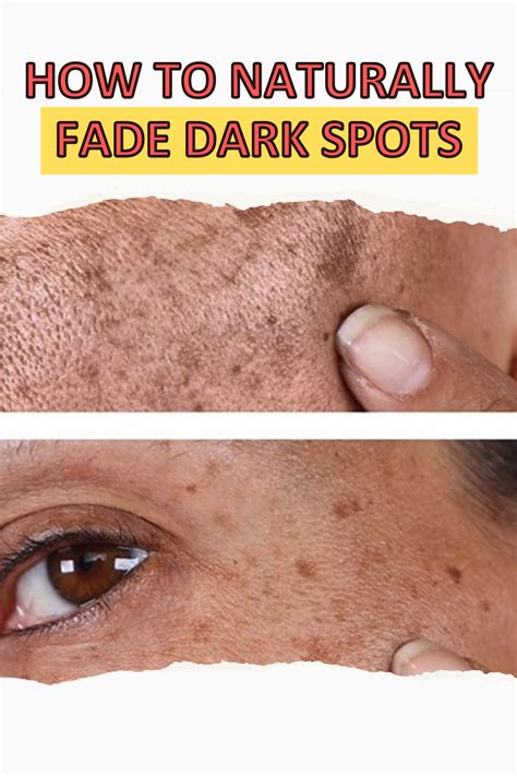 how to get rid of dark spots at home