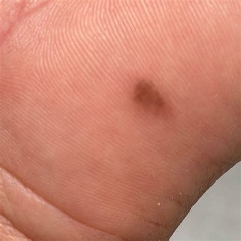 Acral Nevus (ICD-10: D22) - Online consultation AI dermatologist