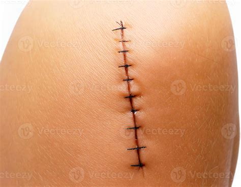 pictures of healed stitches