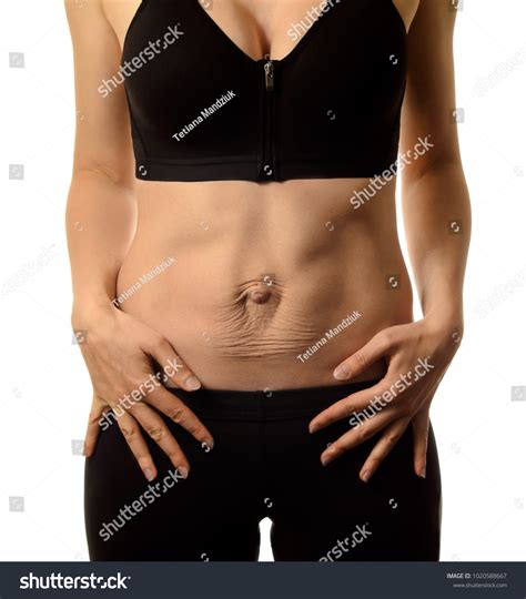 Diastasis Recti Womans Abdomen Divergence Muscles Stock Photo