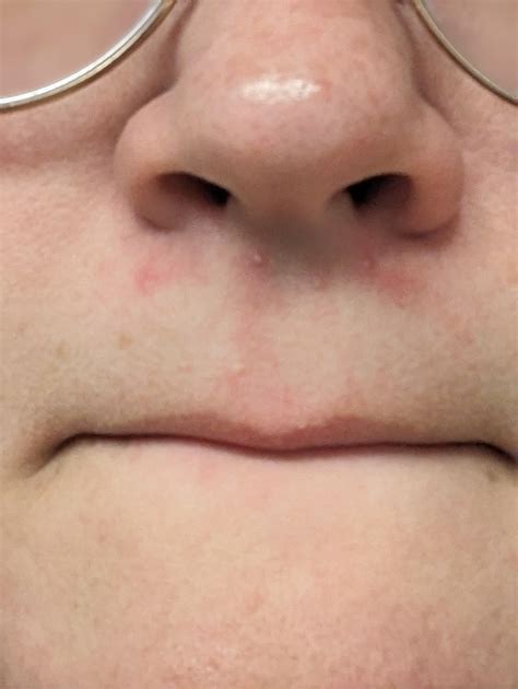 Upper lip whiteheads : r/30PlusSkinCare