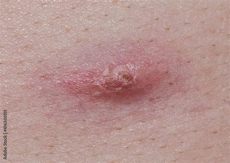 Acne pimple on Caucasian skin beginning to scab and heal over. Macro ...