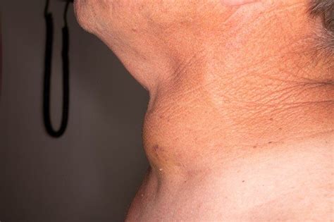 8 Top Thyroid Cancer Symptoms & Signs | MD Anderson Cancer Center