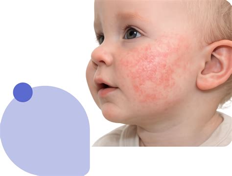 atopic dermatitis treatment   dermatologist