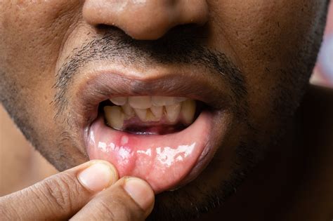 Afta na boca: 8 fatores que podem provocar a lesão - Minha Vida