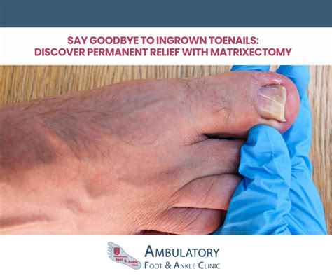 Say Goodbye to Ingrown Toenails: Discover Permanent Relief with ...