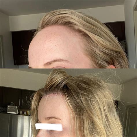 hairline lowering cm  days post op rplasticsurgery