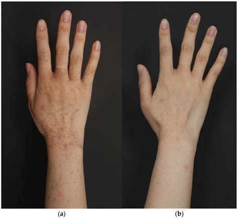 A Case of Unilateral Hyperpigmentation