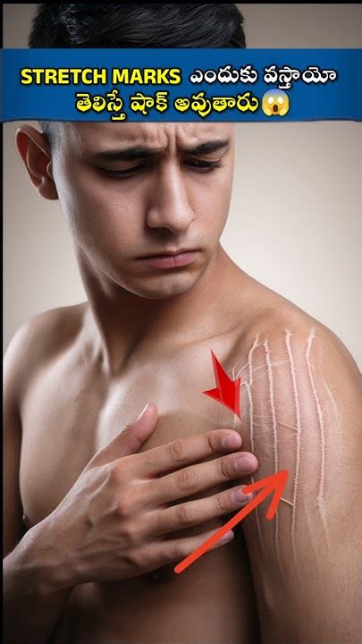 stretch marks bashrinfacts stretch viralshort