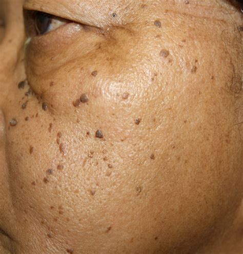 Dermatosis Papulosa Nigra | Dermatologist Philadelphia | Dermatology