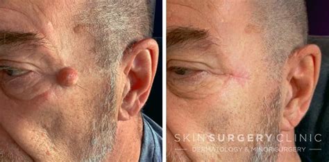 Cyst Removal from £425 | Skin Surgery Clinic