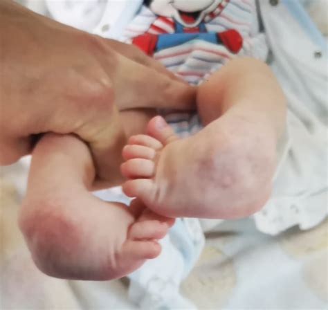 piciorul stramb congenital piciorul varus equin pve rosana medical