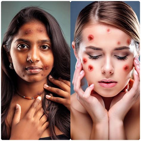 Recurring boils in your hidden areas