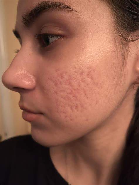 Acne scars from severe acne : r/AcneScars