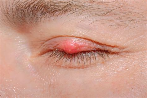 Meibomian Gland Dysfunction (MGD) - Piyavate - Hospital
