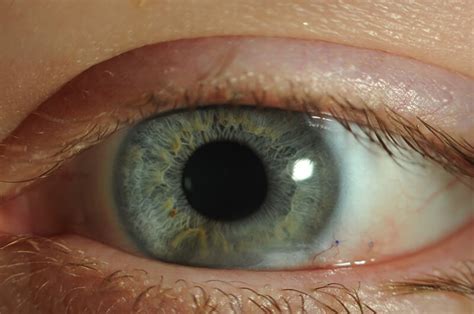 corneal surgery    appearance mark  vital md
