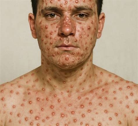 Síntomas de la Viruela: Todo Lo Que Debes Saber del Virus.