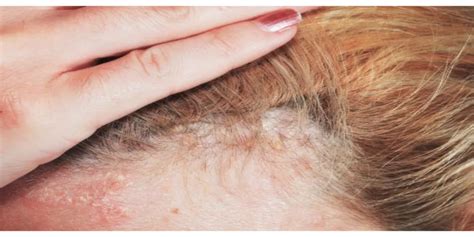 اليكم طرق فعالة في علاج صدفية الشعر في المنزل وطبيا | الطبي