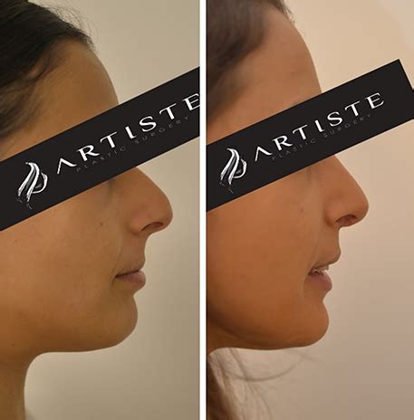 Nose Job - Rhinoplasty - Plastic Surgery Hub