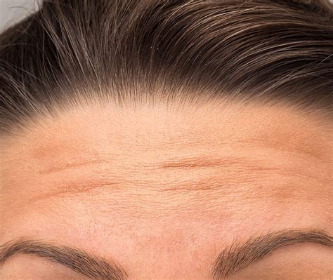 forehead lines treatment captivate iv wellness beauty bar