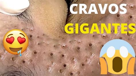 Cravos E Espinhas Gigantes 2024 - Cravos Gigantes- Espremendo cravos e espinhas gigantes #Viral # ...