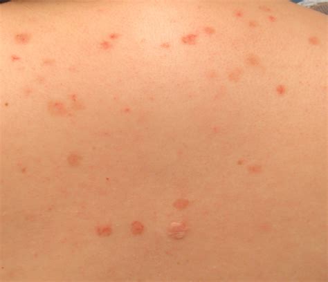 pemphigus in cats 6