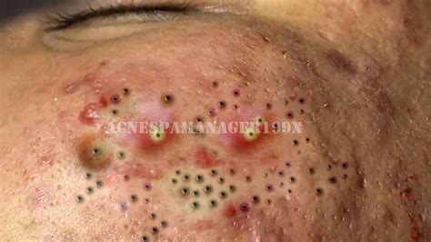 Unbelievable Blackhead Removal 2024: From Blemishes to Beautiful Skin - ke10i3f