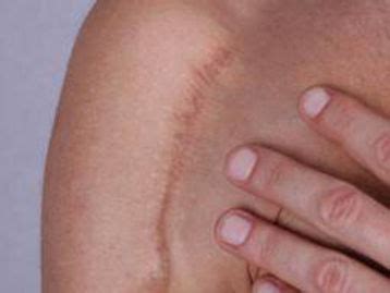 scarring injury lawyers  houston austin dallas