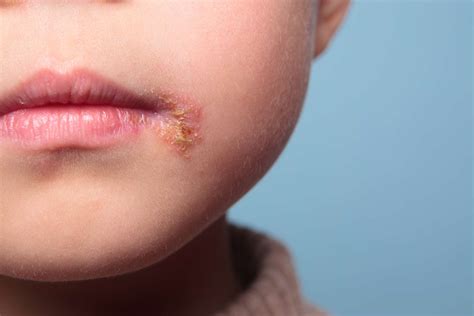 Common Skin Rashes in Children: 16 Types and Causes