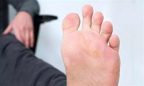 plantar warts  treated active care podiatry