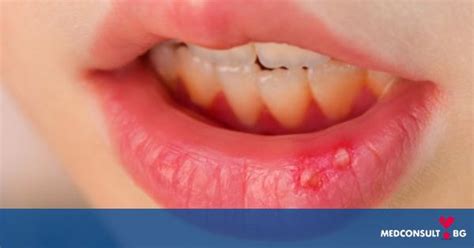 Стоматит - симптоми и лечение — Medconsult.bg