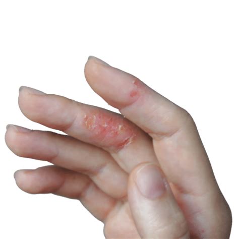 Hand Dermatitis – Melbourne Skin & Dermatology clinic