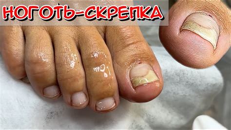 Ноготь-скрепка /Почему ноготь скручивается? / Онихолизис ногтей ...