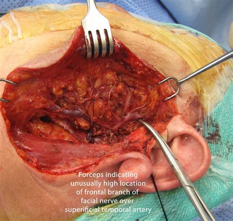 Temporal Arteritis (Giant Cell Arteritis) and Temporal Artery Biopsy ...
