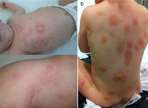 Diffuse cutaneous mastocytosis. Presentation of 3 cases and therapeutic