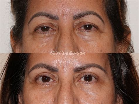 Upper Eyelid Blepharoplasty | Eyelid Lift — Barnet Dulaney Perkins Eye