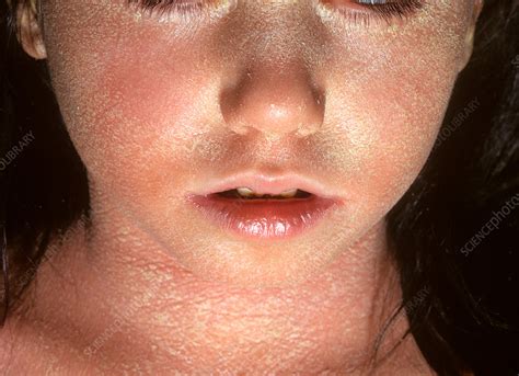 Pityriasis rubra pilaris - Stock Image - C032/0482 - Science Photo Library