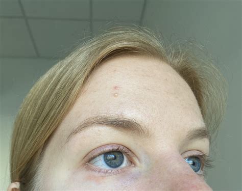 Does anyone know what these red rashes under my eyes are ? : r