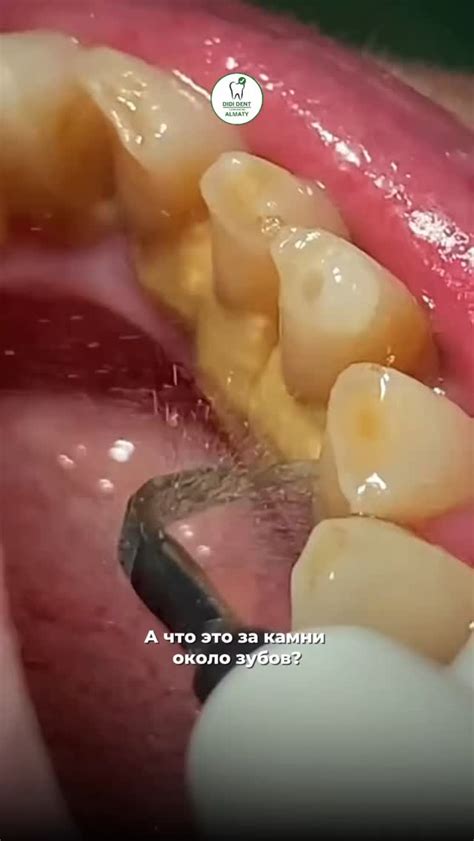 Хотите так же избавиться от камней на зубах? 🫣