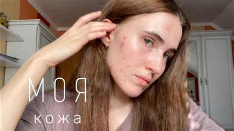 Как принять свою кожу | видео спустя 1 год - YouTube