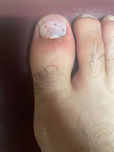 Blood Under the Toe Nail from Injury Urgent Care Walk-in Medical Care